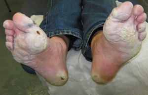 TrenchFoot